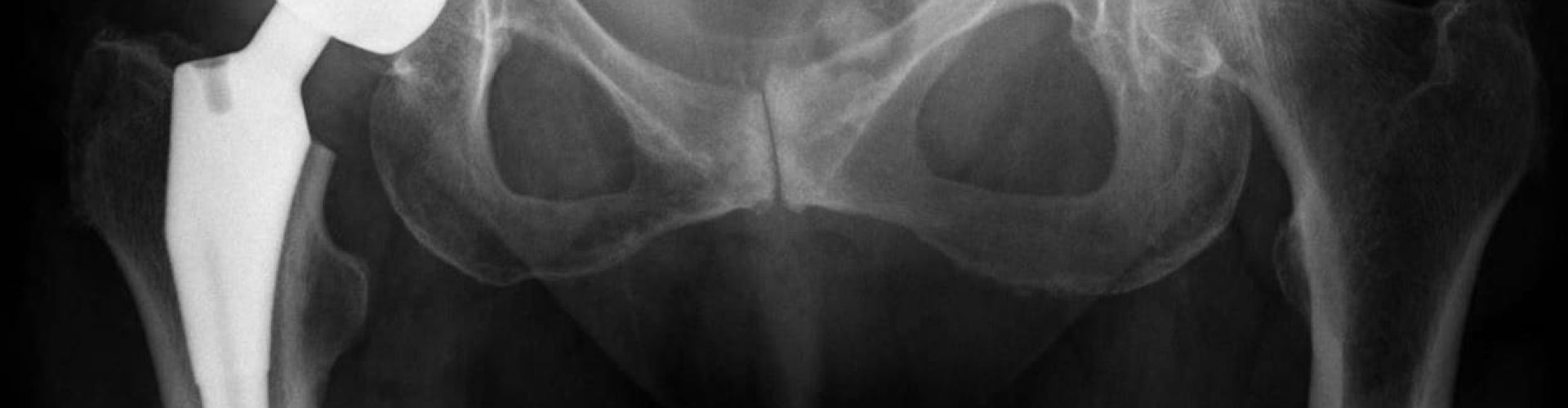 hip-replacement_2