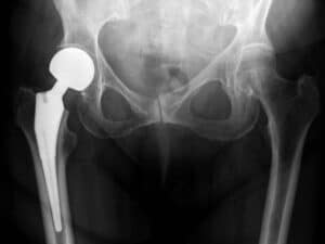 Blog JP Morgan hip replacement 2 Daniels Law Firm